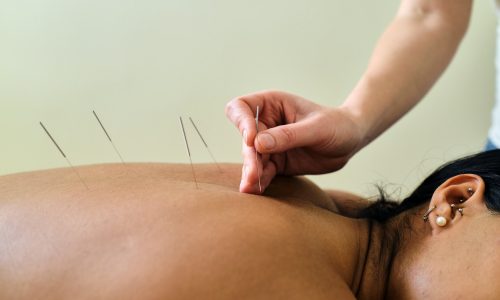 Masseuse putting acupuncture needles in young latin girl's back.